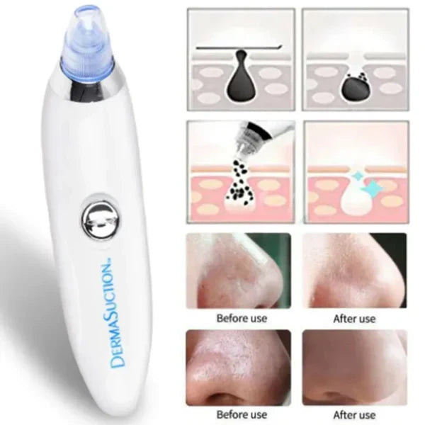 DERMA SUCTION | Pore Vacuum Cleaner