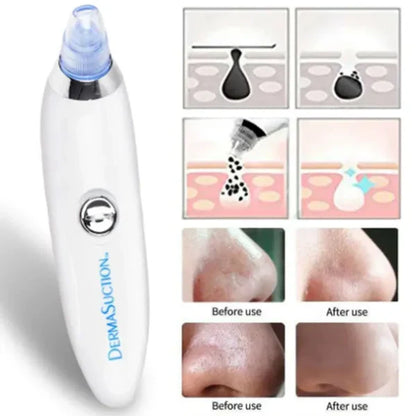 DERMA SUCTION | Pore Vacuum Cleaner